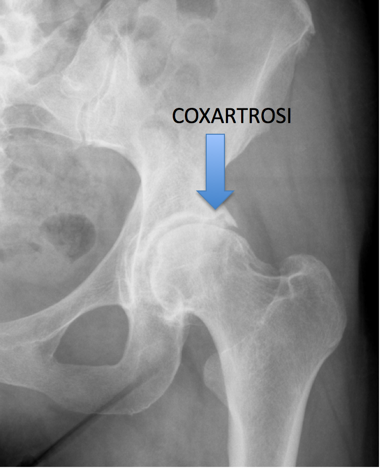 COXARTROSI